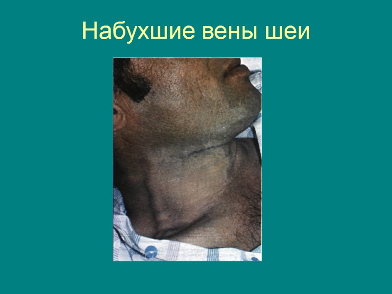 Набухшие вены шеи